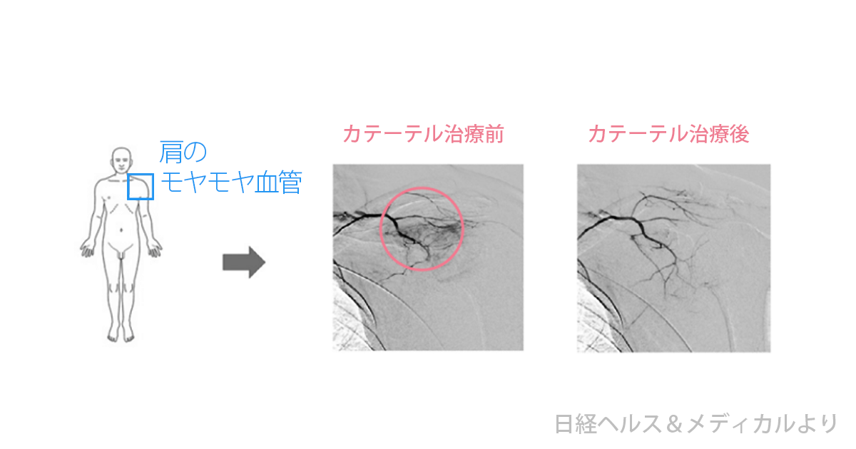 カテーテル治療でモヤモヤ血管が消失